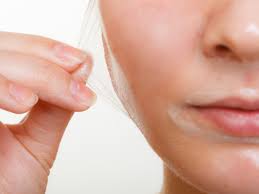 CHEMICAL PEEL TREATMENT