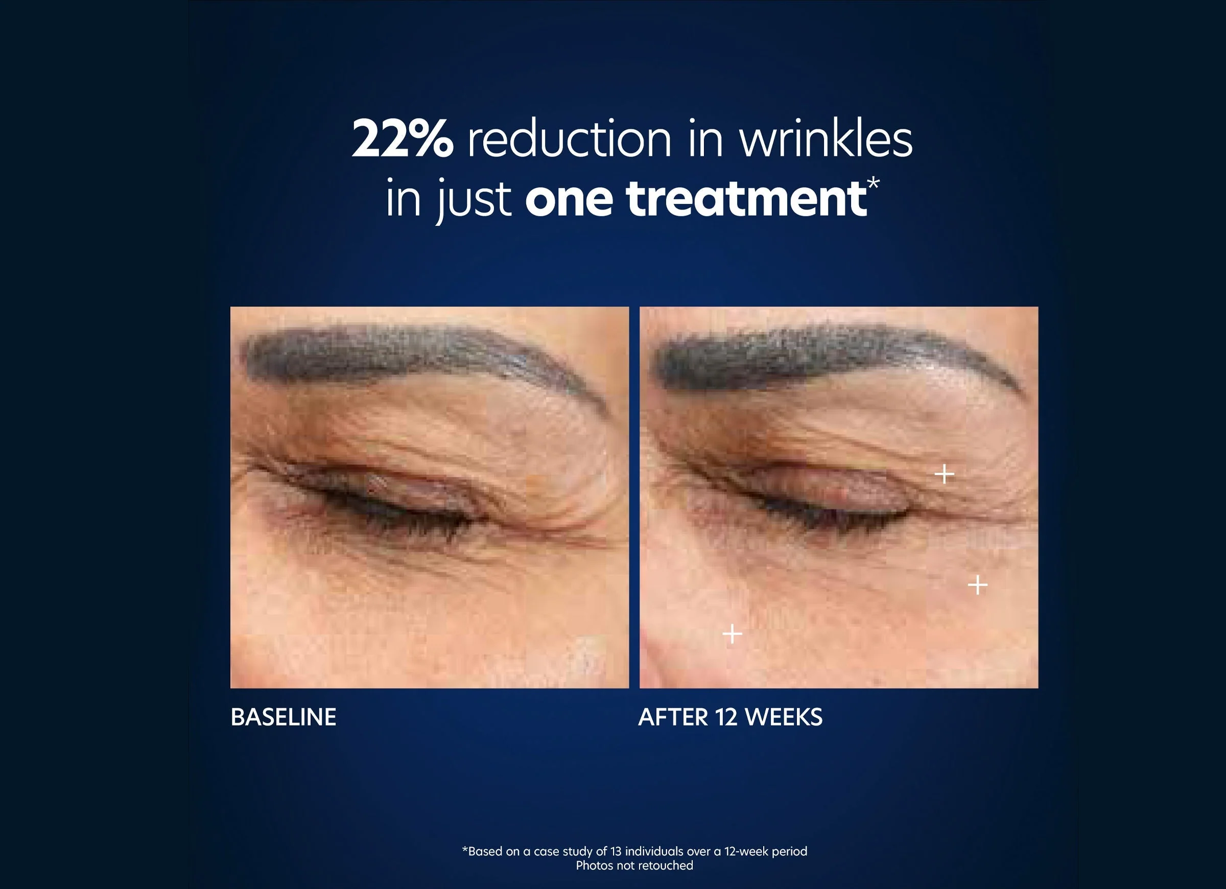 Hyaluronic Acid Microneedle Eye Patches - Image 5