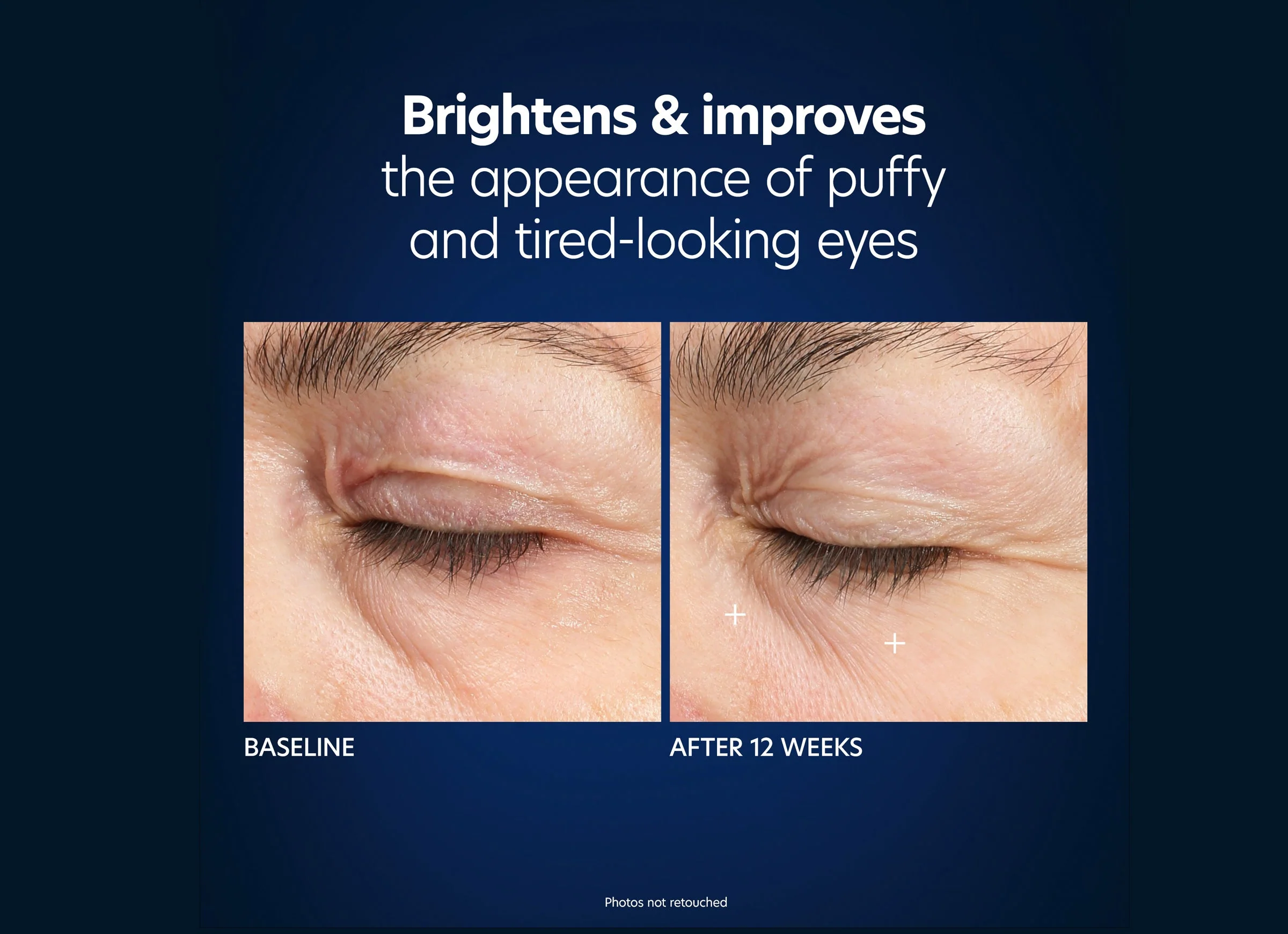 Hyaluronic Acid Microneedle Eye Patches - Image 7