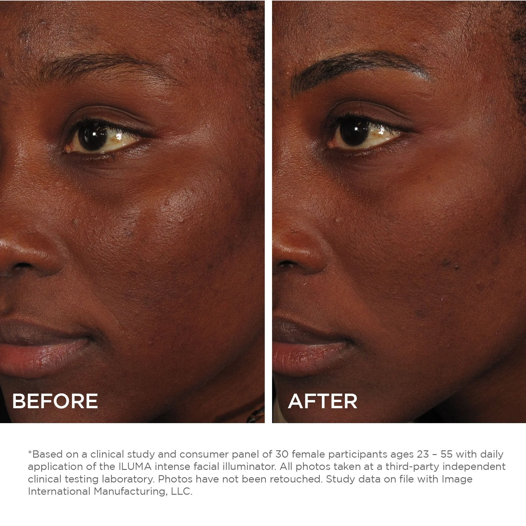 ILUMA intense facial illuminator - Image 2