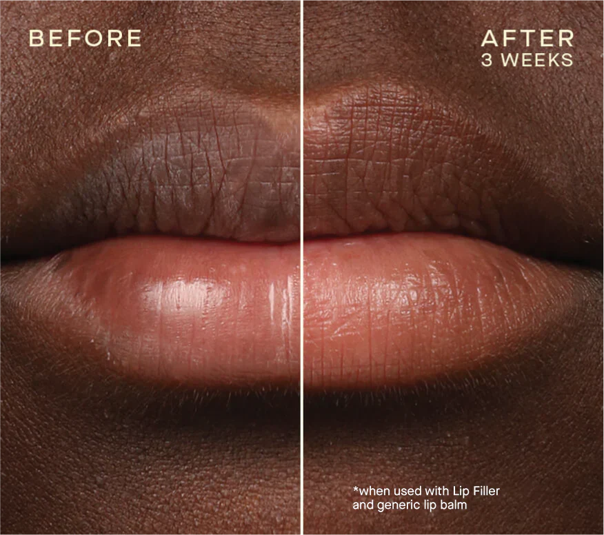 Lip Filler - Image 5