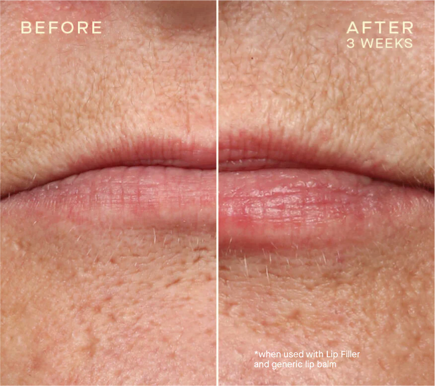 Lip Filler - Image 6