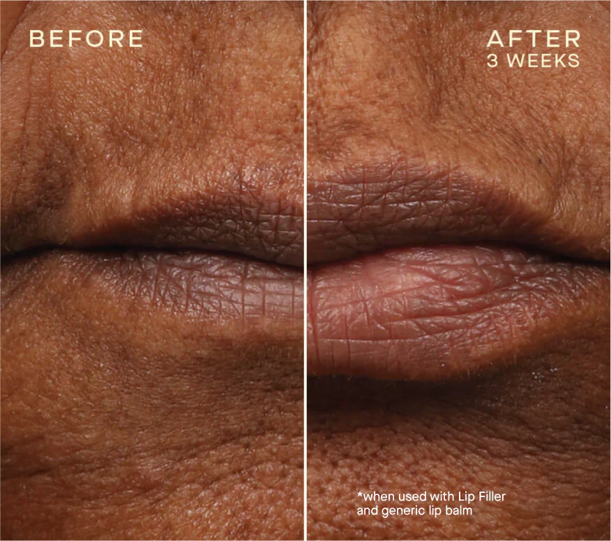Lip Filler - Image 7