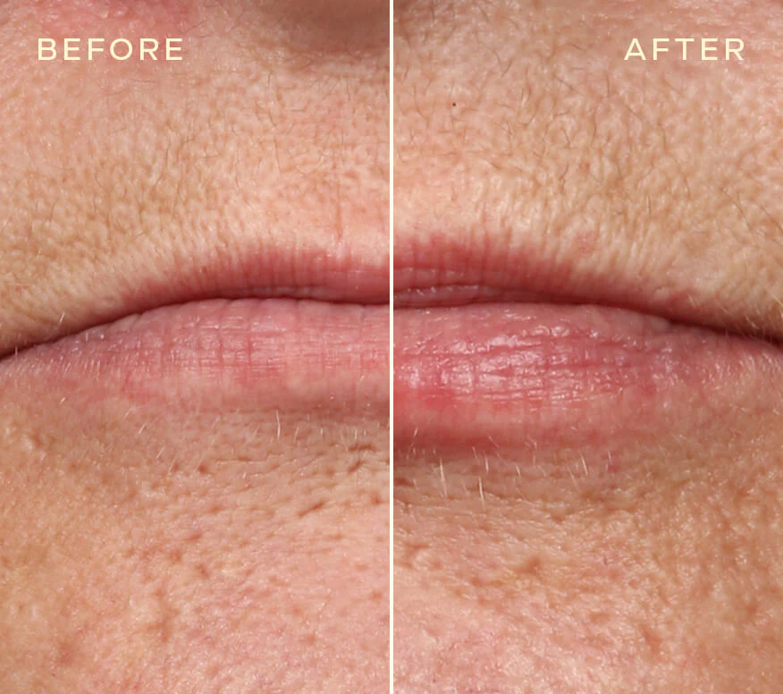 Lip Filler Refill - Image 4