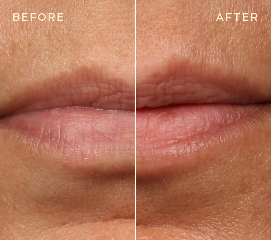 Lip Filler Refill - Image 5