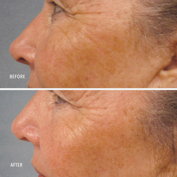 LUMAPRO-C SERUM - Skin Brightening Pigment Corrector - Image 4