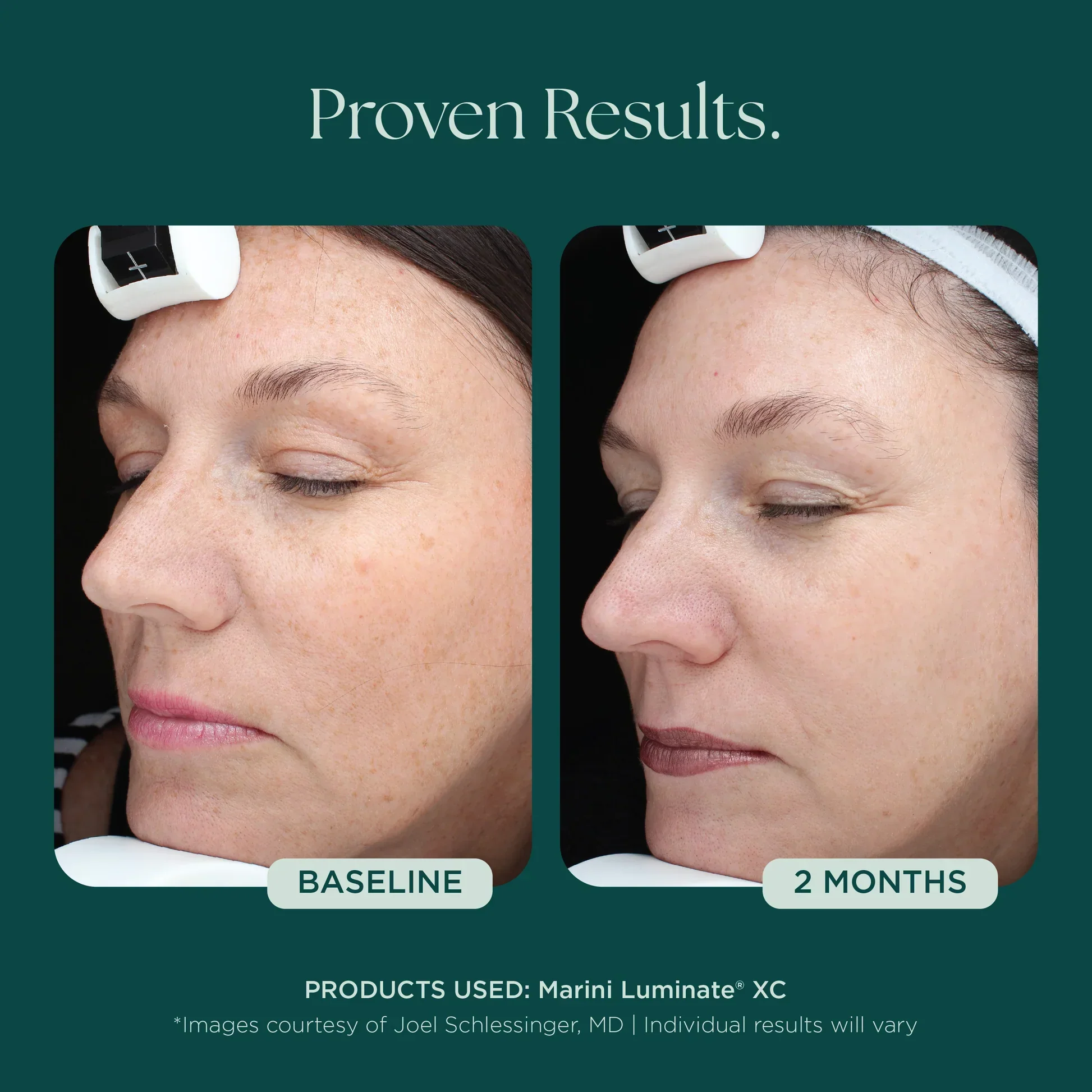 Marini Luminate® XC - Image 4