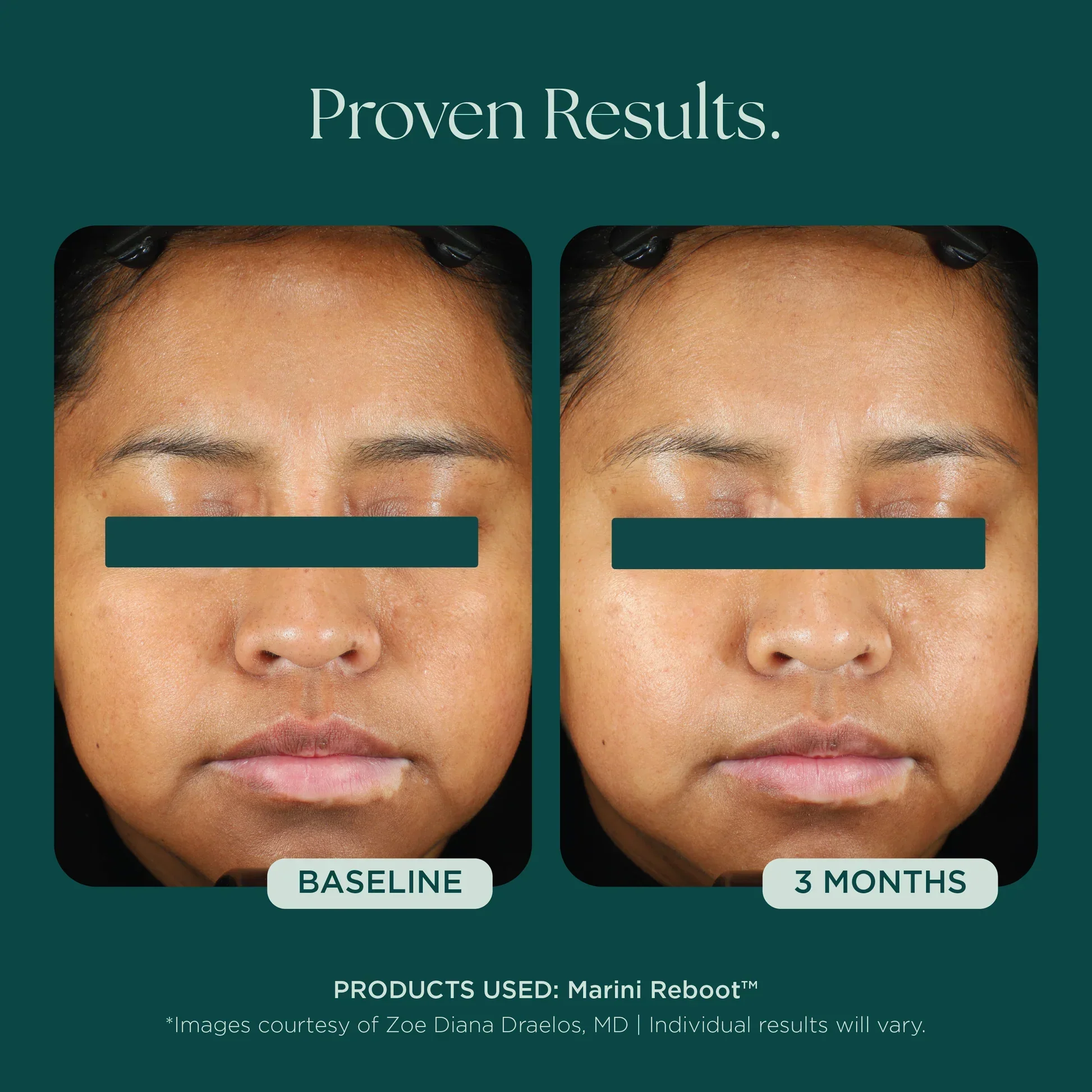 Marini Reboot® PDRN Face Serum - Image 4