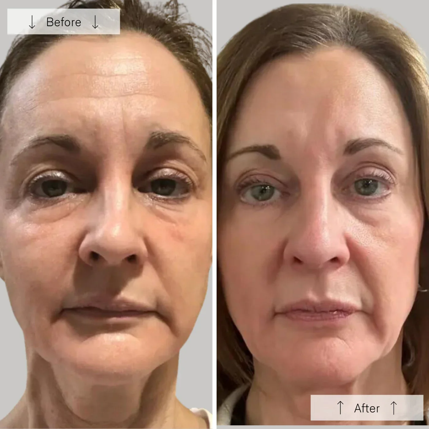 Omnilux Contour Face - Image 12
