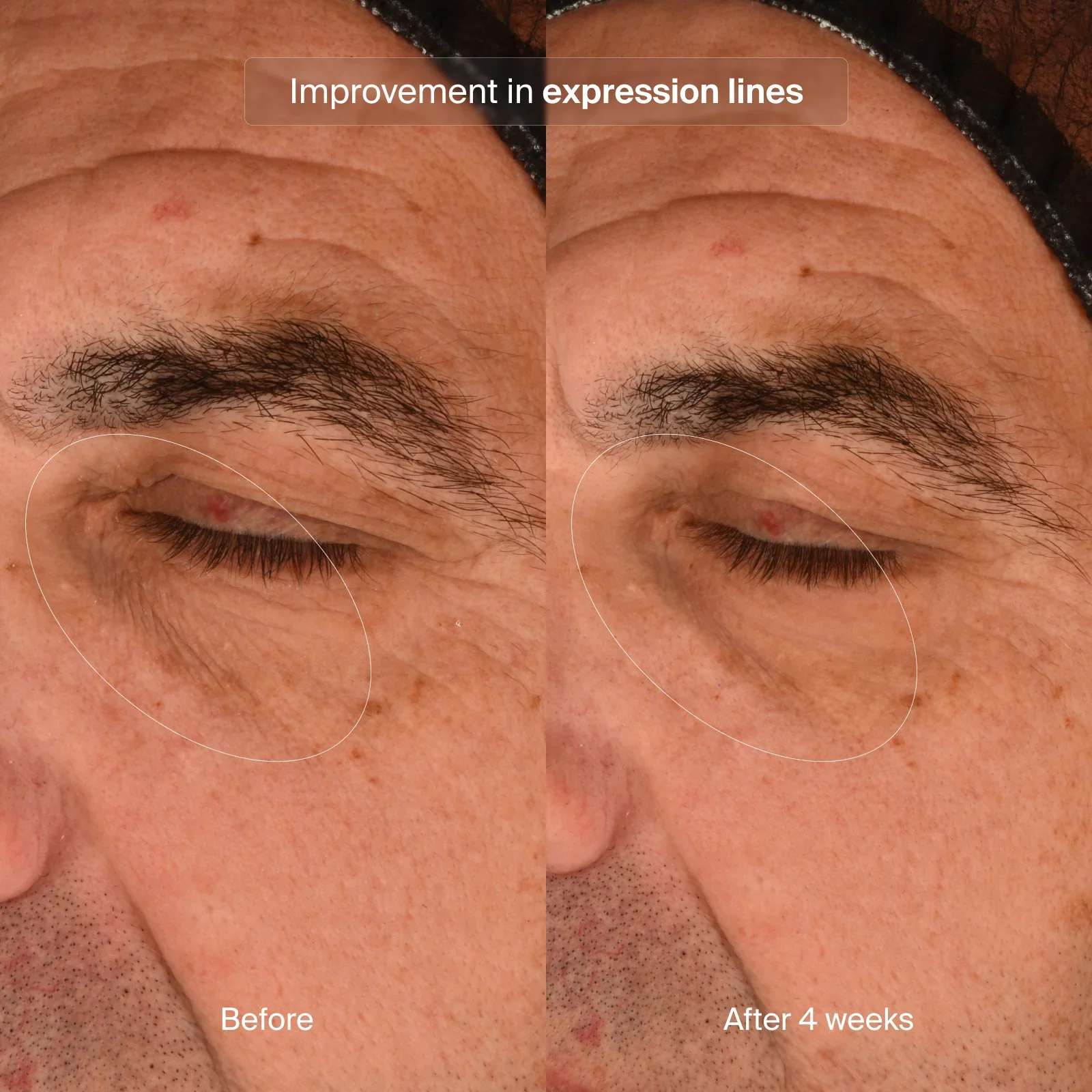 PRECISION EYE LIFT - Image 7