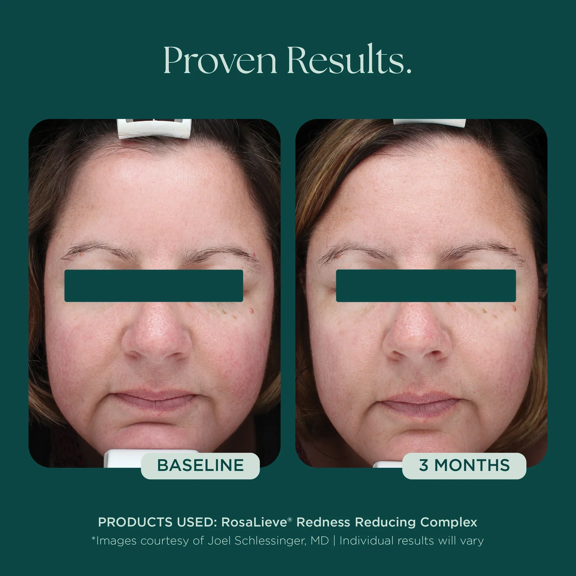 RosaLieve® Redness Reducing Complex - Image 3