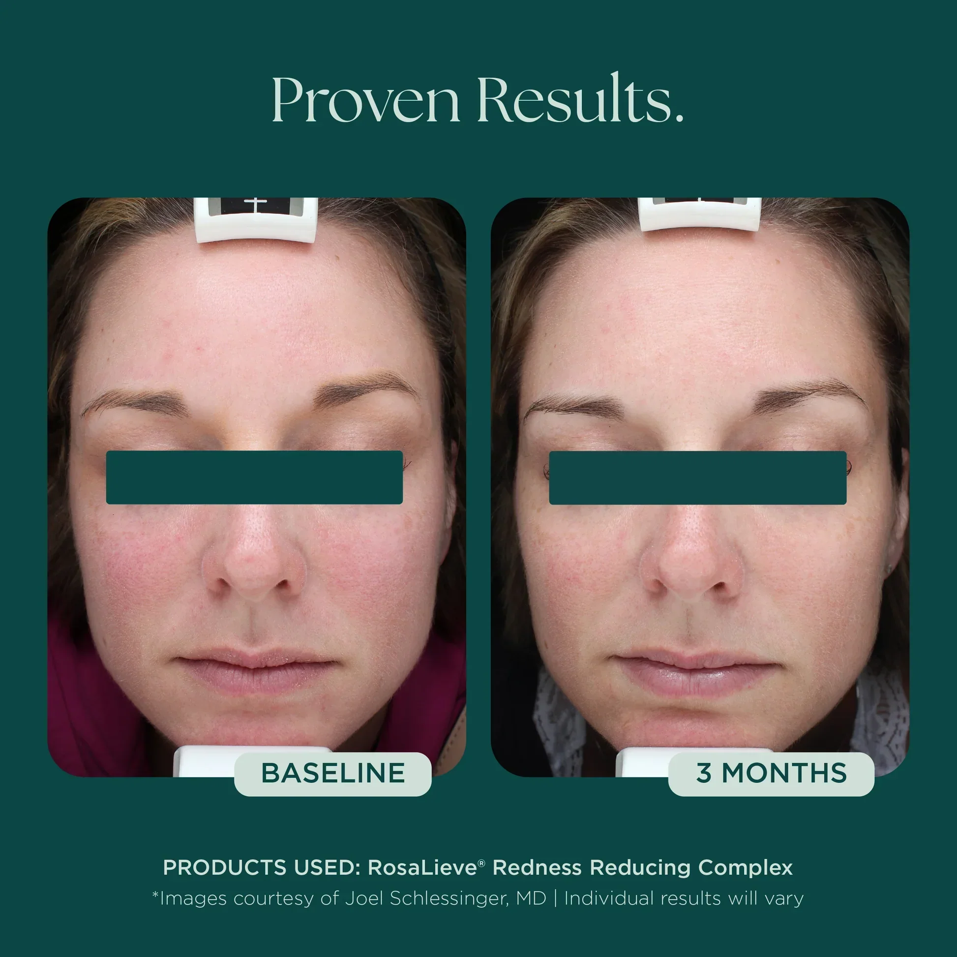 RosaLieve® Redness Reducing Complex - Image 4