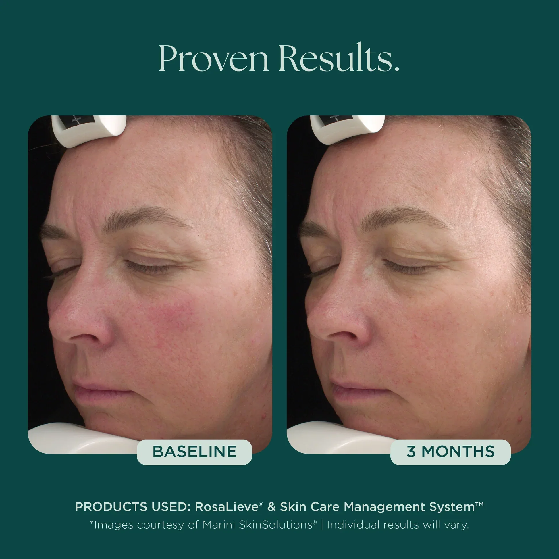 RosaLieve® Redness Reducing Complex - Image 5
