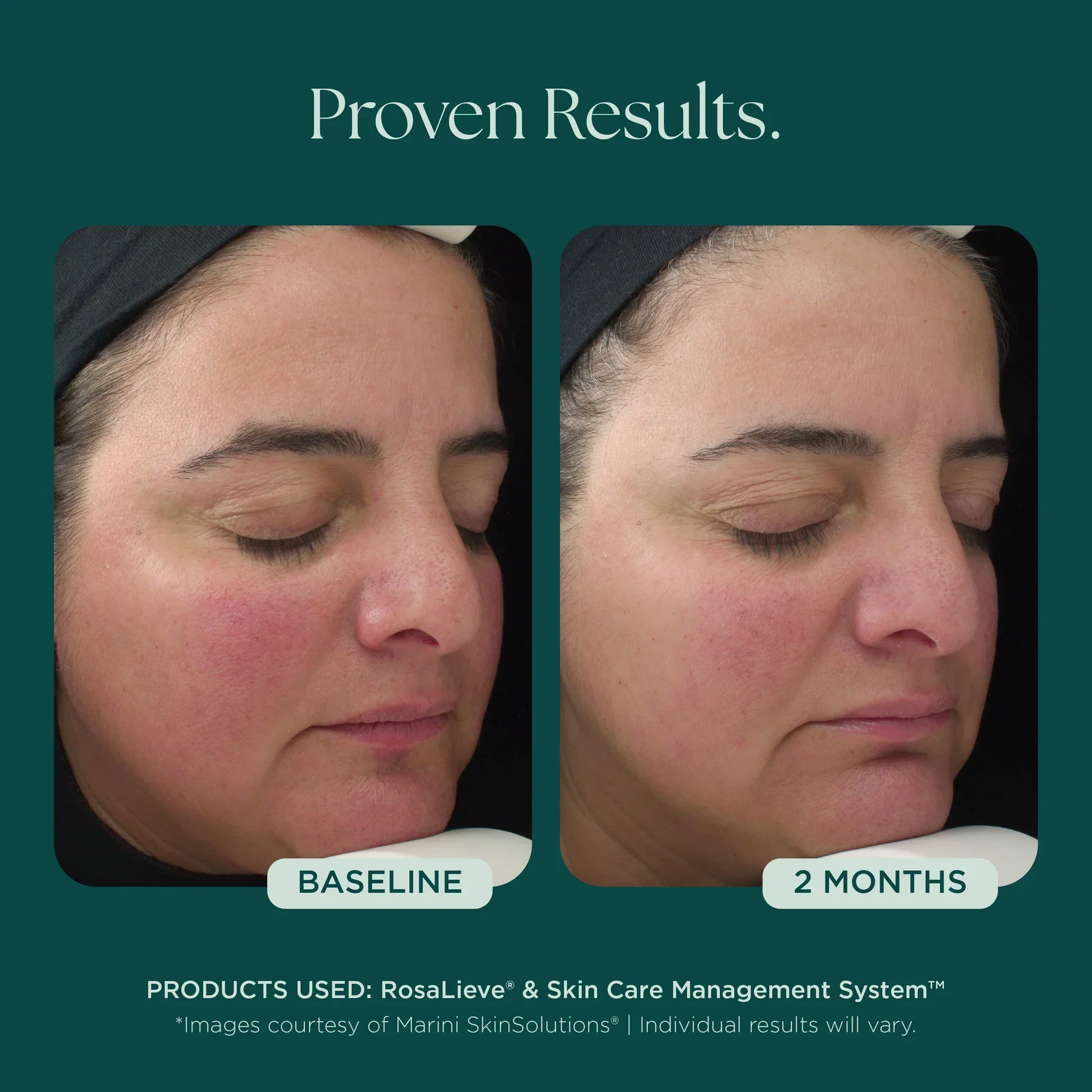 RosaLieve® Redness Reducing Complex - Image 8